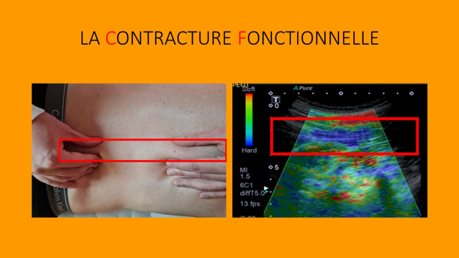 CONTRACTURE FONCTIONNELLE | Korrexos L’Enthésothérapie, qu’est-ce que c’est ? Schiltigheim 0
